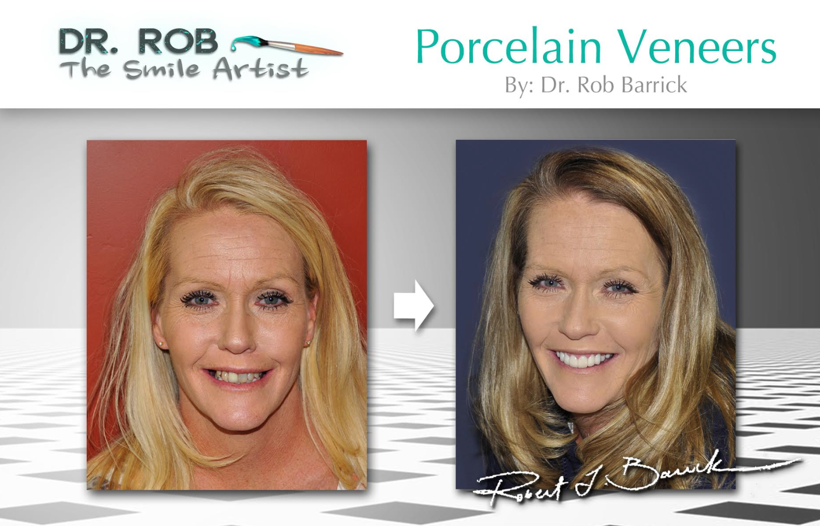 Before and after veneer placement — seamless cosmetic dental work
