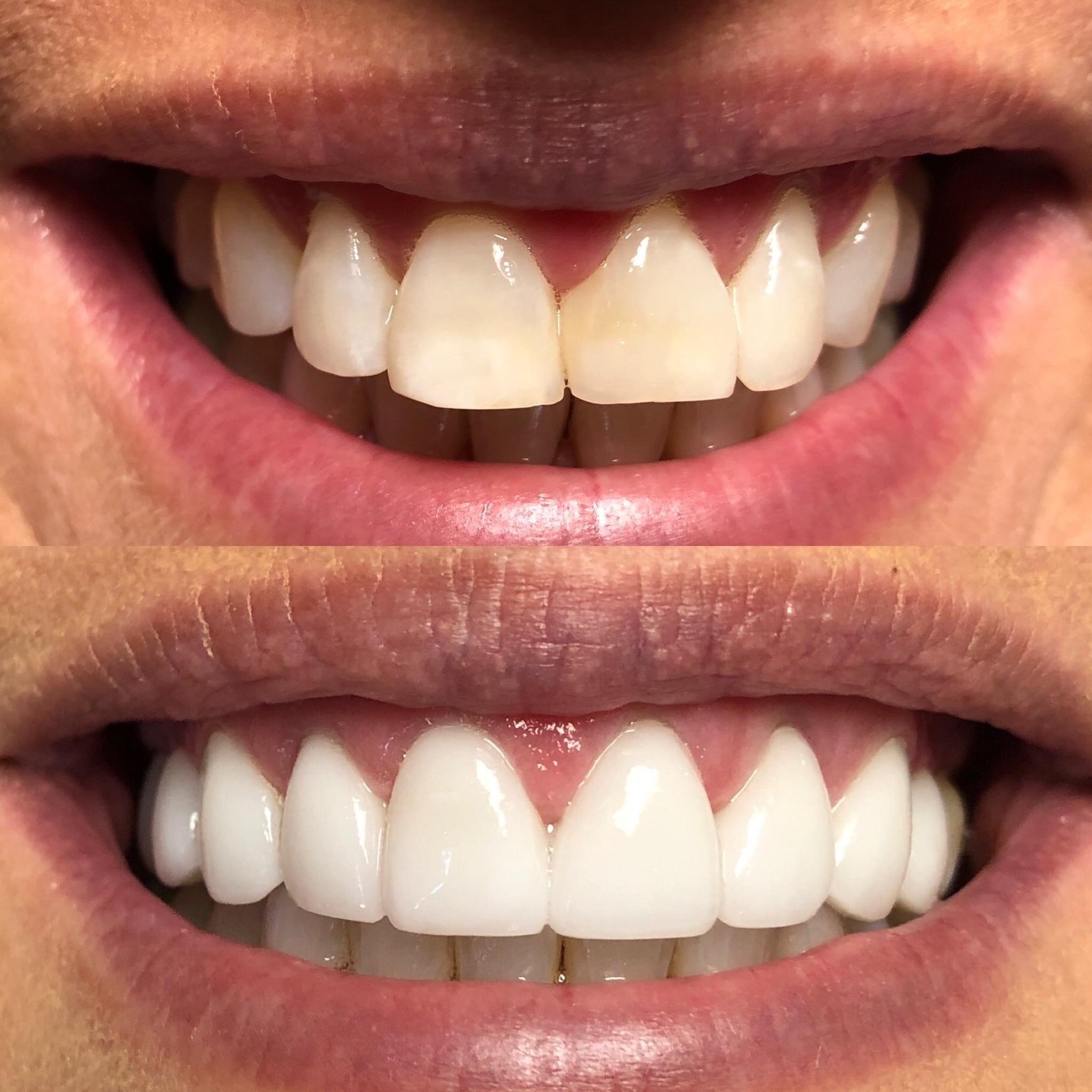 Before and after smile makeover showing natural-looking veneer results