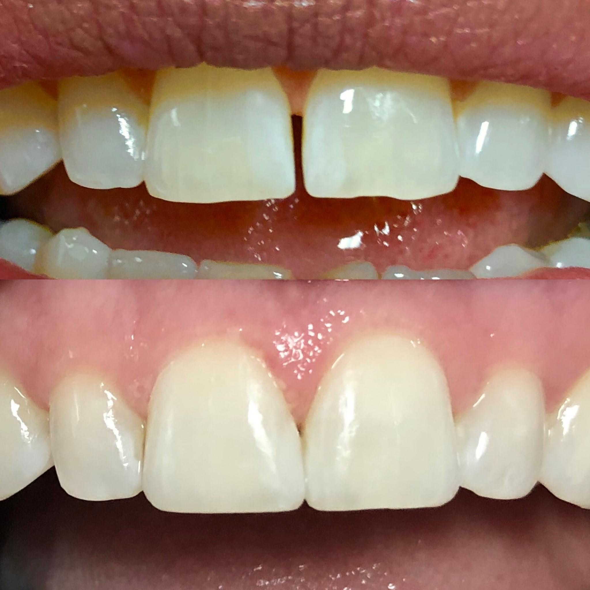 Before and after dental restoration — full smile redesign by The Smile Artist