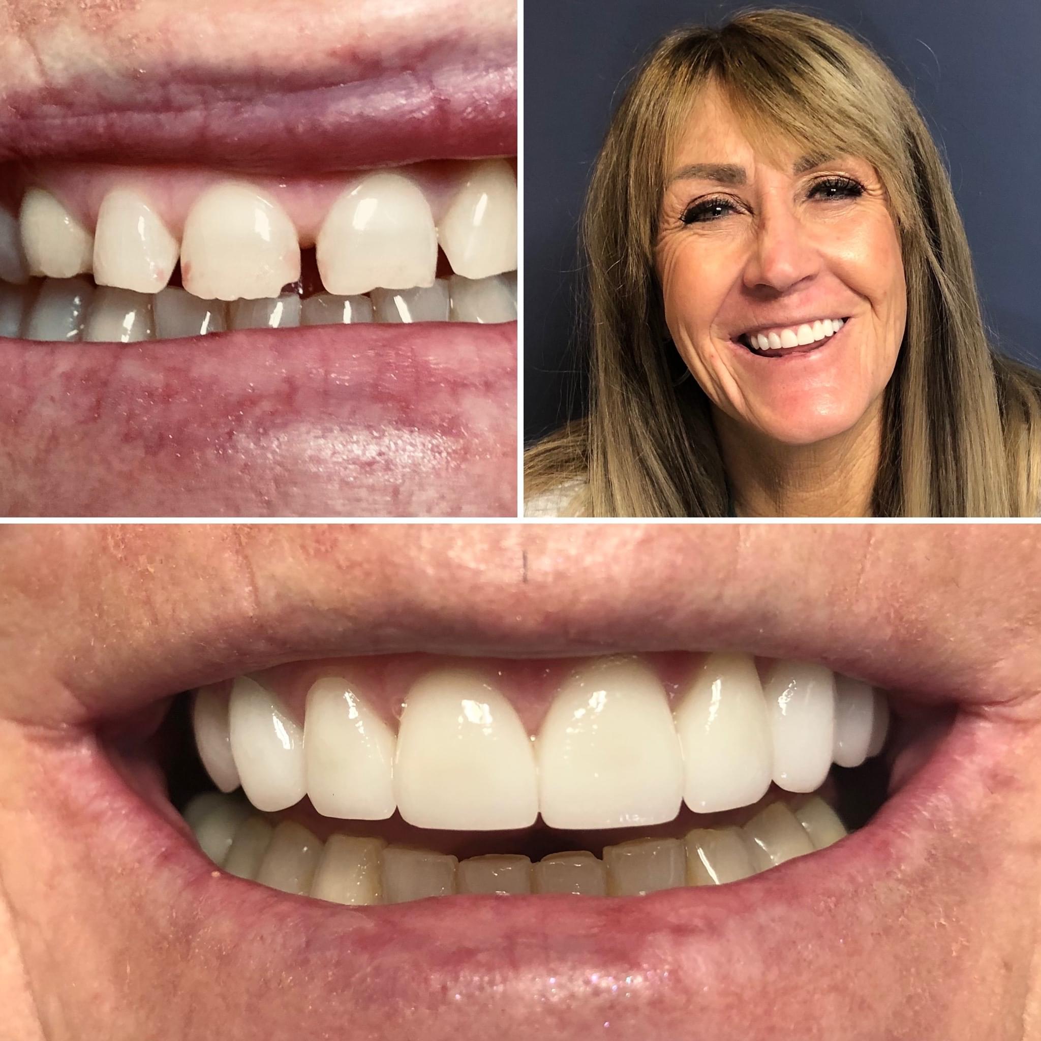 Before and after cosmetic veneers — confident new smile for Southern Utah patient