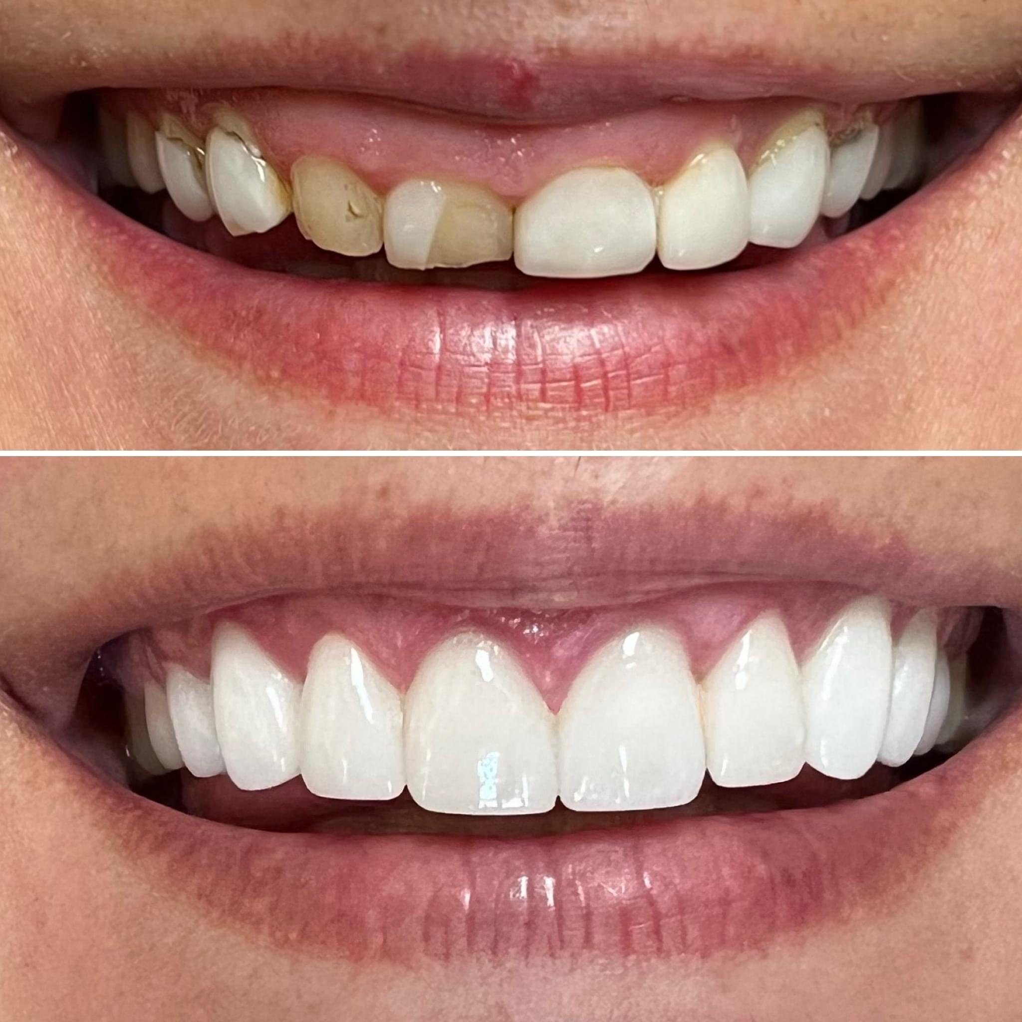 Before and after teeth transformation — custom porcelain work by Dr. Rob