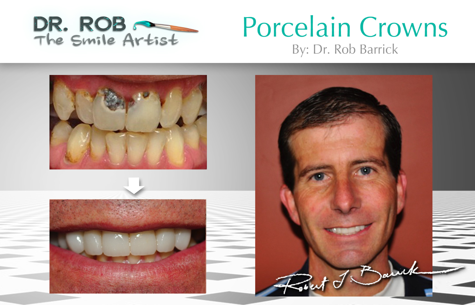 Before and after veneer case — improved tooth alignment and color matching