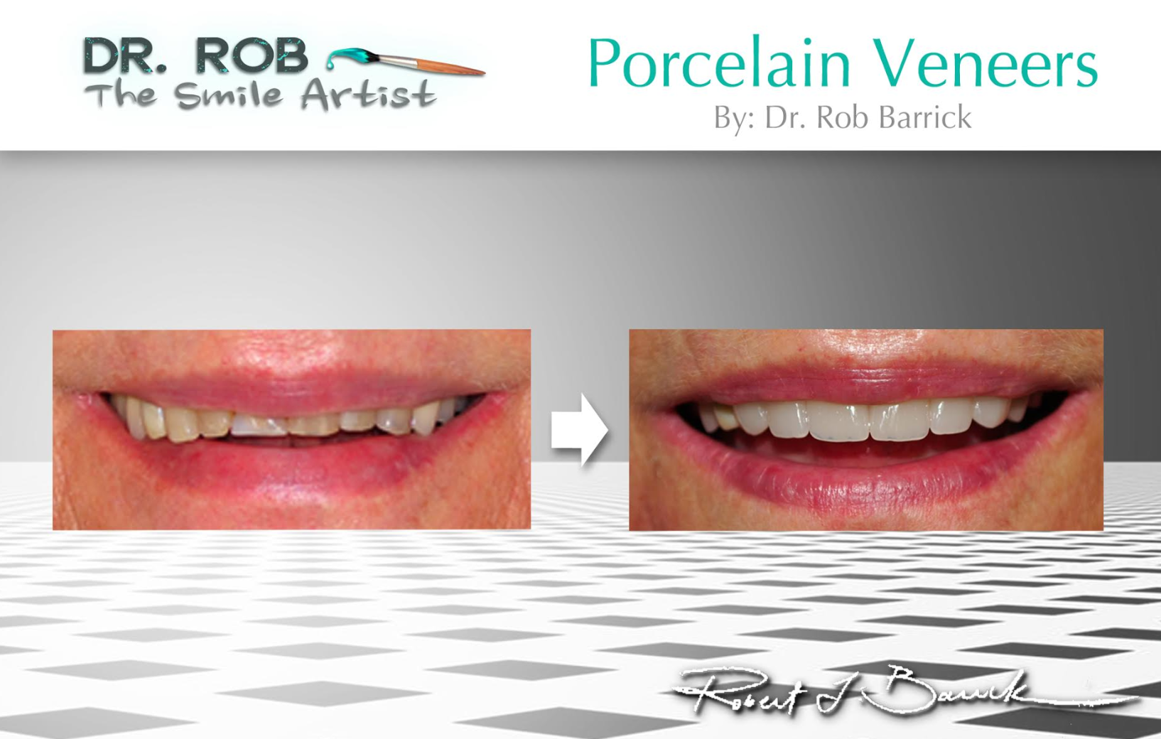 Before and after dental cosmetic treatment — brighter, straighter smile result