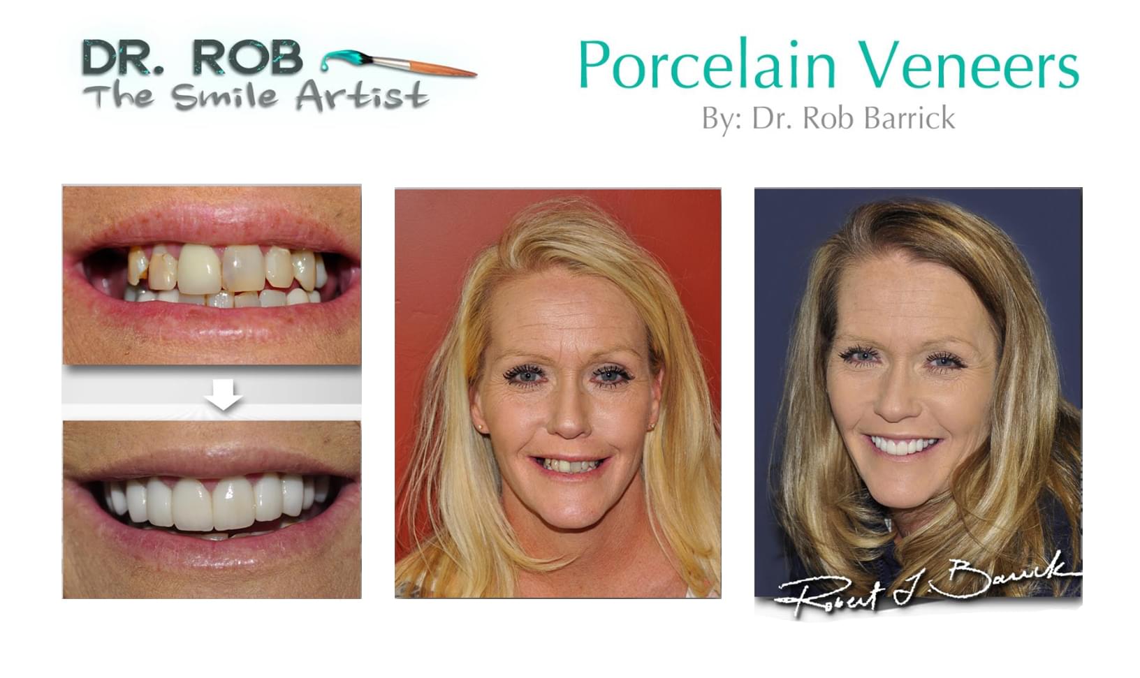 Composite of multiple before and after smile transformations by Dr. Rob Barrick