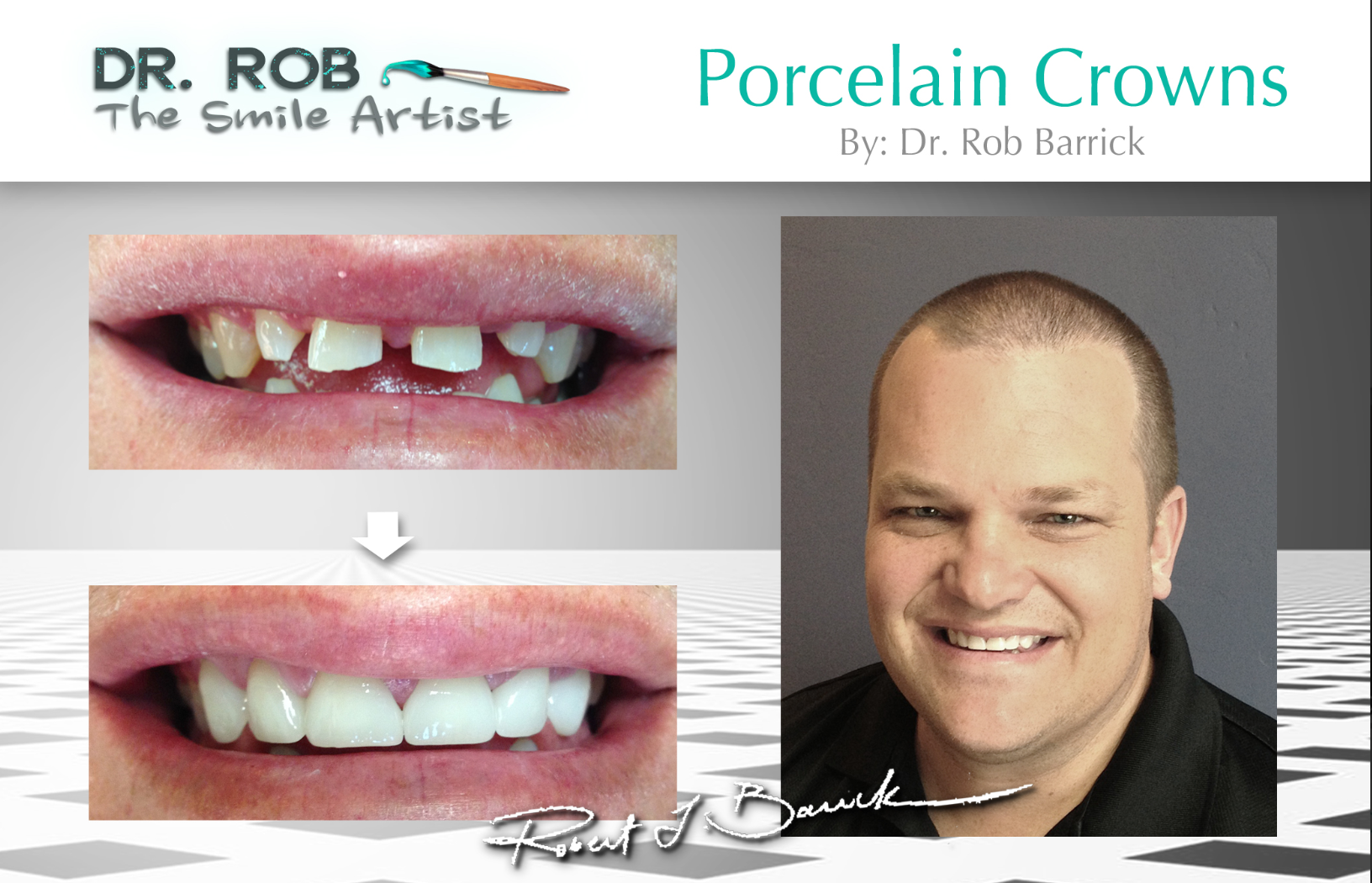 Mike Green's smile transformation — porcelain veneers by Dr. Rob Barrick
