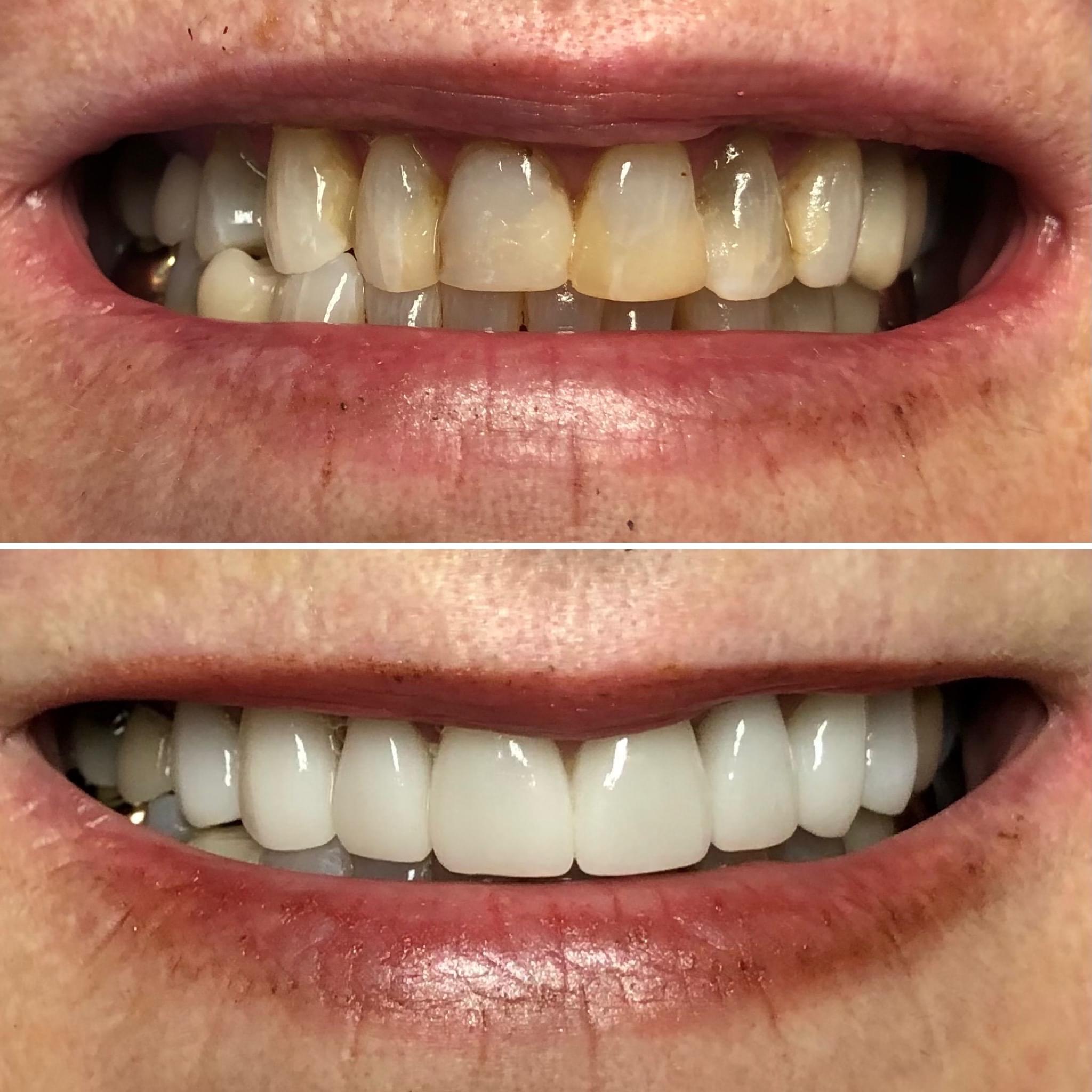 Beautiful smile result after cosmetic veneer treatment at Cedar Dental Center