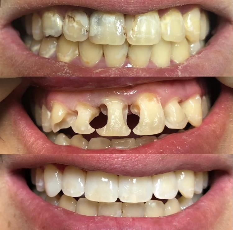 Radiant smile showcasing natural-looking porcelain veneers by Dr. Rob