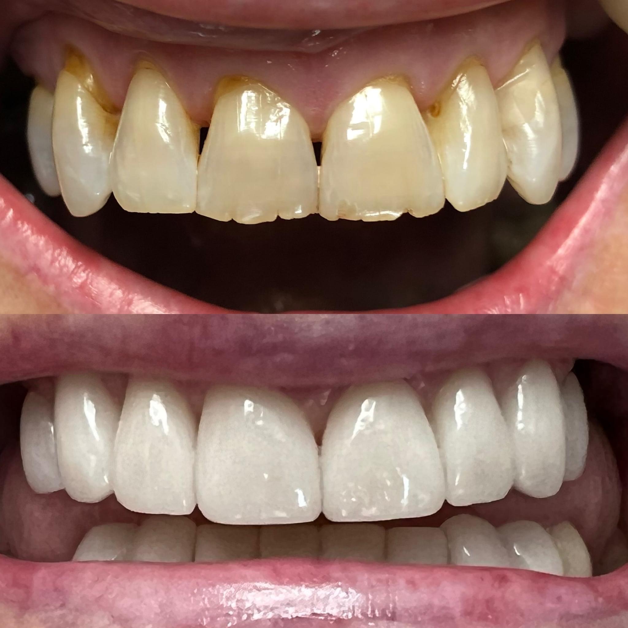 Patient smiling confidently after smile makeover in Cedar City