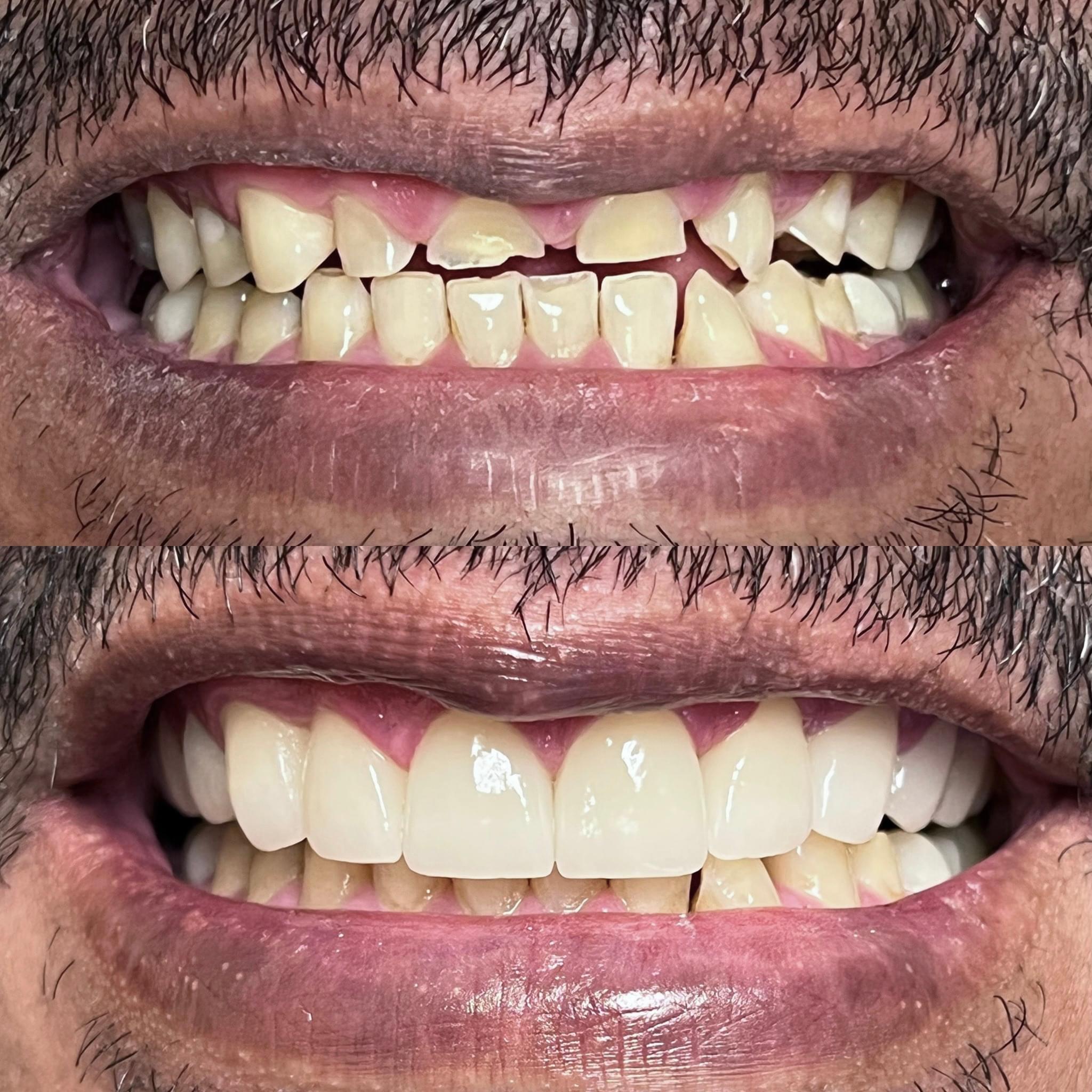 Close-up of stunning veneer results — bright, even smile