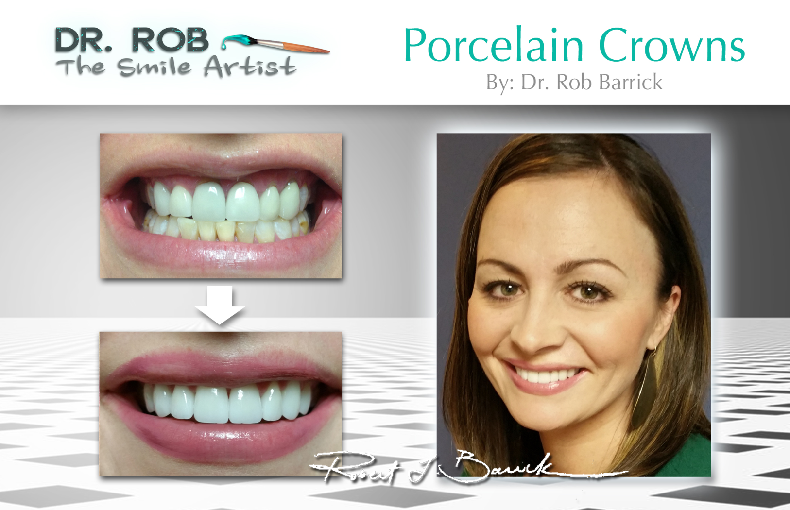 Sundi's before and after smile makeover — complete cosmetic veneer transformation