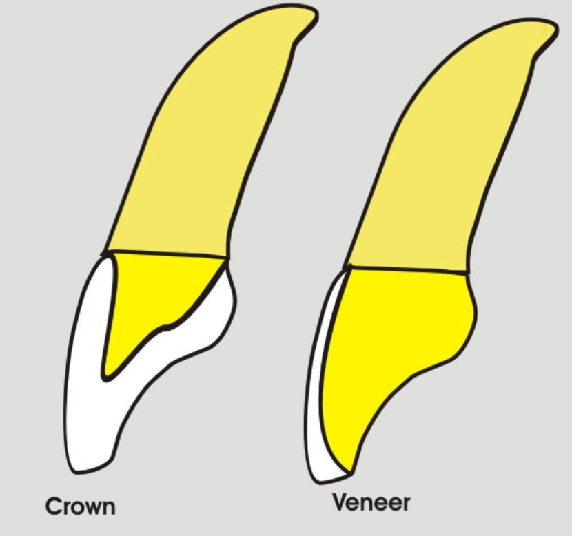 Illustration comparing a dental crown and a porcelain veneer